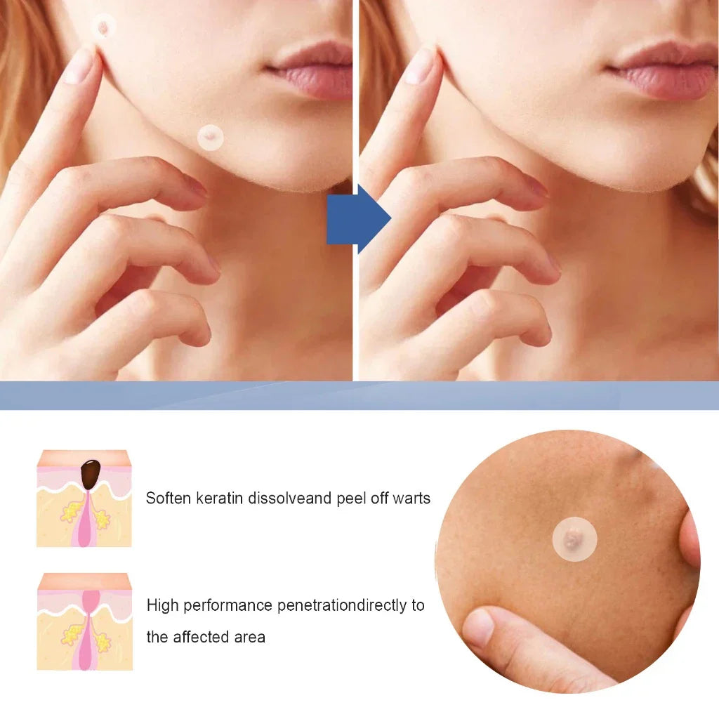 EELHOE Skin Tag Patch Mole and Wart Remover Herbal Extract Invisible Warts Stickers 144pcs
