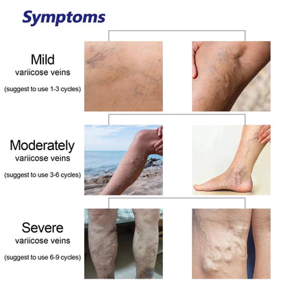 Sol Lora Varicose veins Cream (BUY 1 GET 1 FREE)