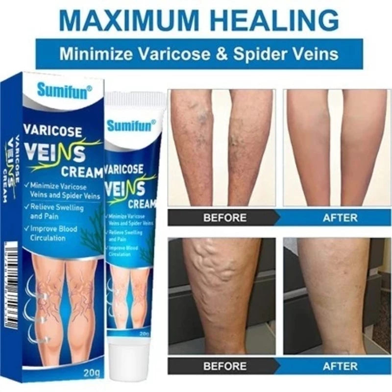 Sol Lora Varicose veins Cream (BUY 1 GET 1 FREE)