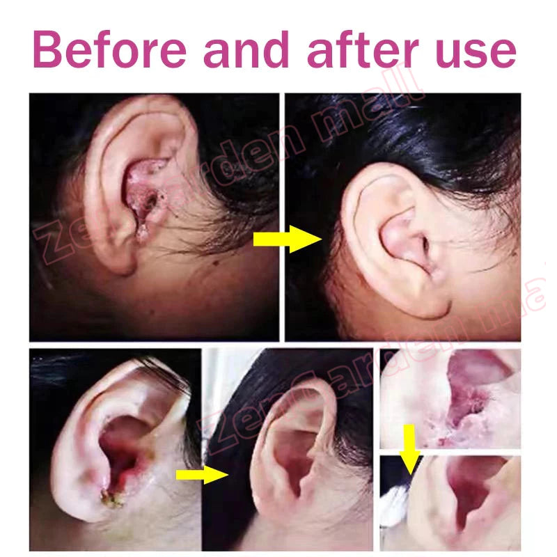 HBESTY Tinnitus Spray Multi-Symptom Relief  ( BUY 1 GET 1 FREE )